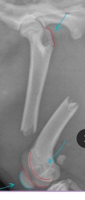 <p><span style="background-color: transparent;"><strong>Femur Fractures</strong></span></p>