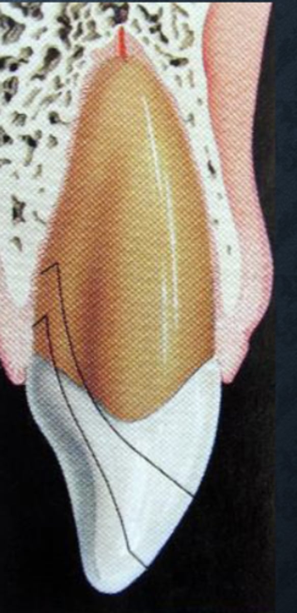 <p>Involves enamel, cementum, and dentin</p><p>May or may not expose the pulp</p>