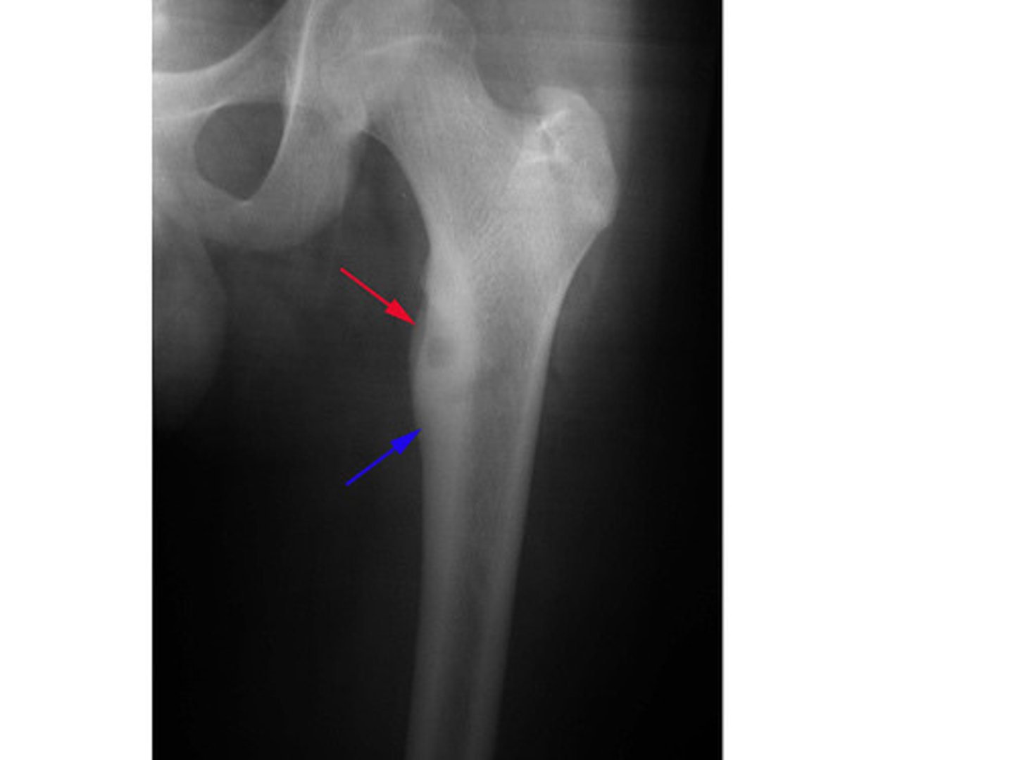 <p>Osteoid osteoma</p>