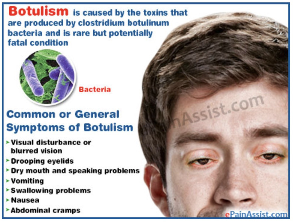 <ul><li><p>blurred vision</p></li><li><p>Respiratory/muscle paralysis</p></li></ul><p></p>