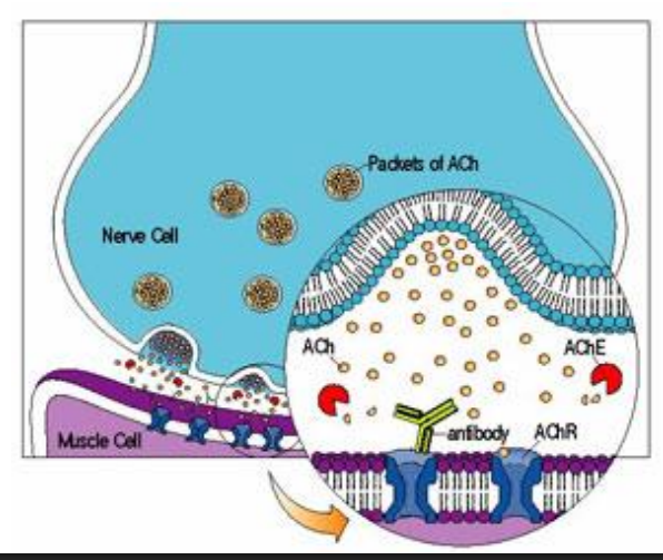 <p>Makes antibodies against receptors → reduces biding of ACh</p><p>Autoimmune condition</p><p>Gradual → blocks receptors then slowly destroys</p>