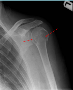 <p>This image shows a __________ _________ fracture </p>