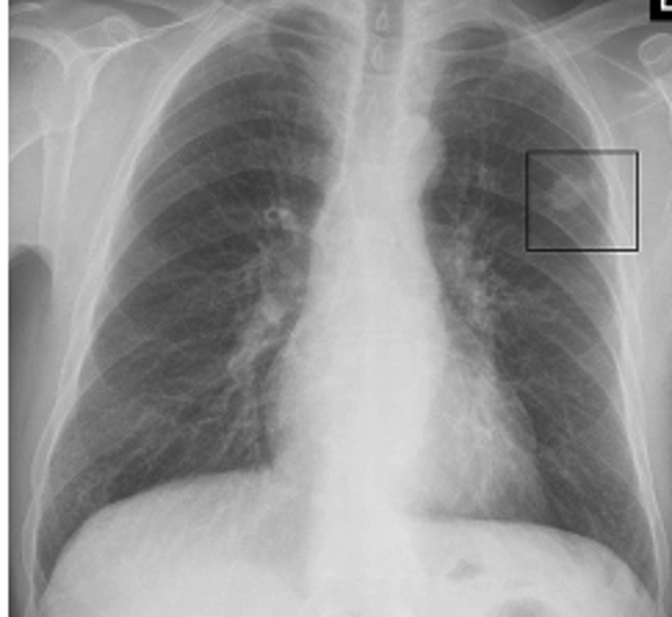 <p>Small, round opacities within the lung parenchyma.CXR Findings:Solitary or multiple nodules. Well-defined or irregular borders.</p>