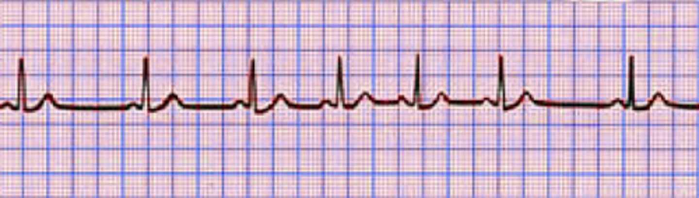 <p>What is a respiratory sinus arrhythmia?</p>