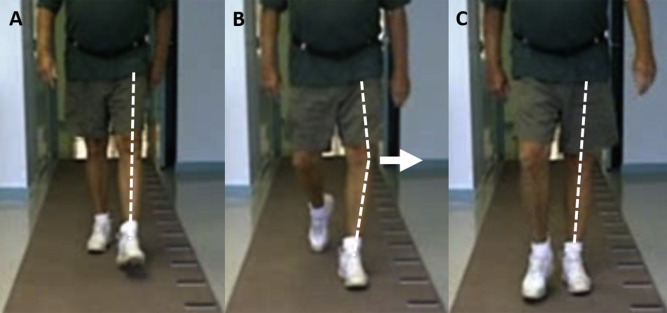 <p><strong>Impairment:</strong> <span style="color: blue">Skeletal deformity or ligament instability</span><br><strong>Deviation/Compensation:</strong> <span style="color: red">Thrust</span> — sudden uncontrolled varus or valgus movement on weight acceptance</p><ul><li><p>Varus <span style="color: red">Thrust</span> in photo</p></li></ul><p></p>