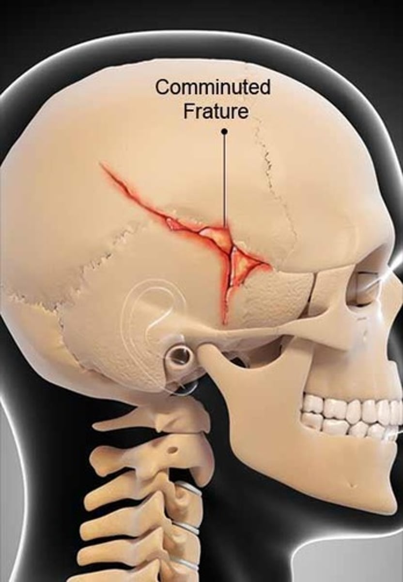 <p>Multiple bone fragments from high-impact injury.</p>