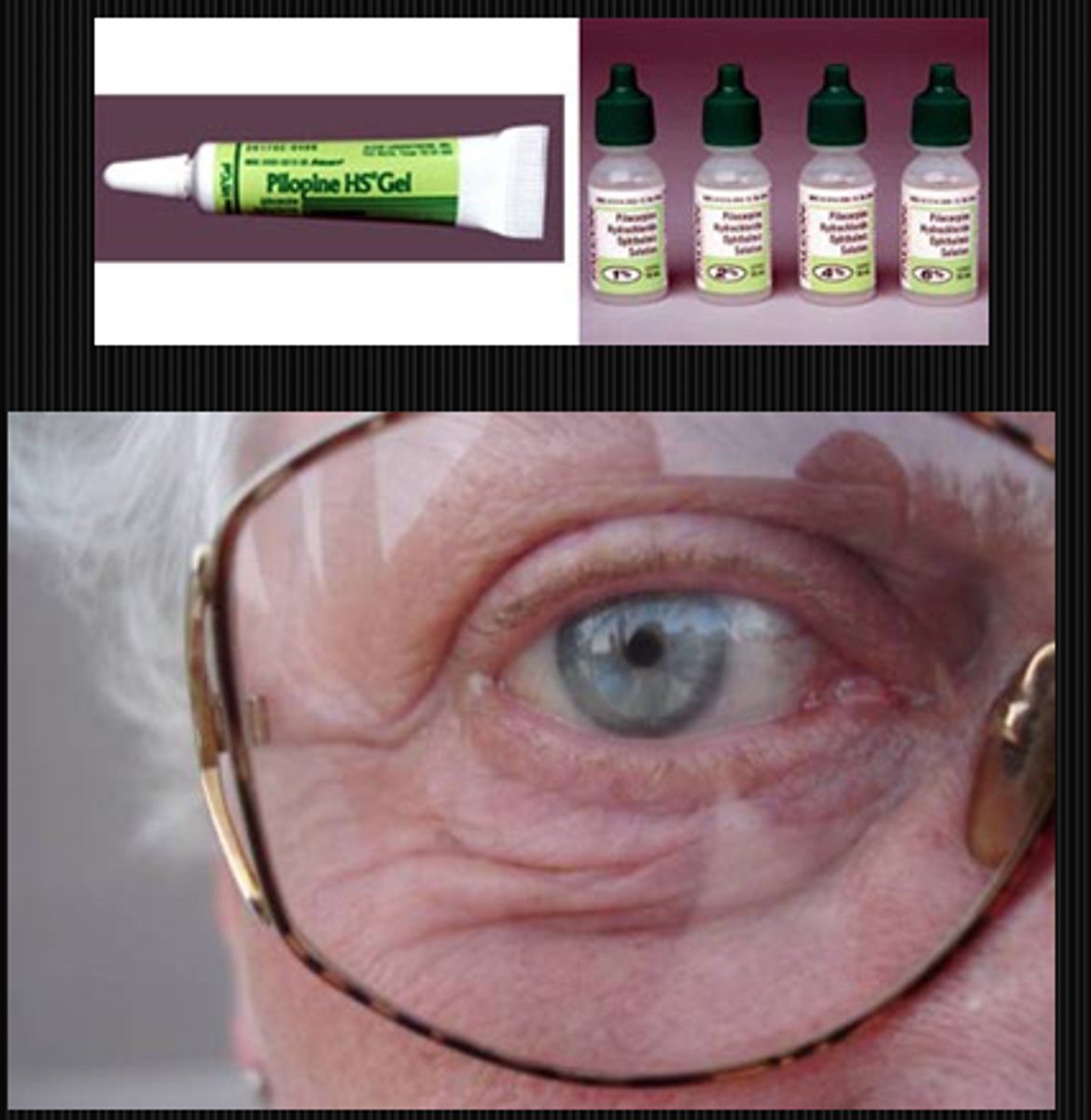 <p>miotic drugs like pilocarpine</p><p>senile miosis due to reduced symp activity with age = increased parasymp dominance</p>