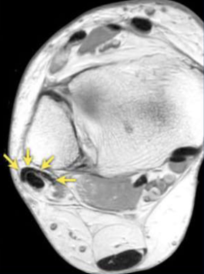 <p>Describe the pathology indicated by the arrow (Ax PD). </p>