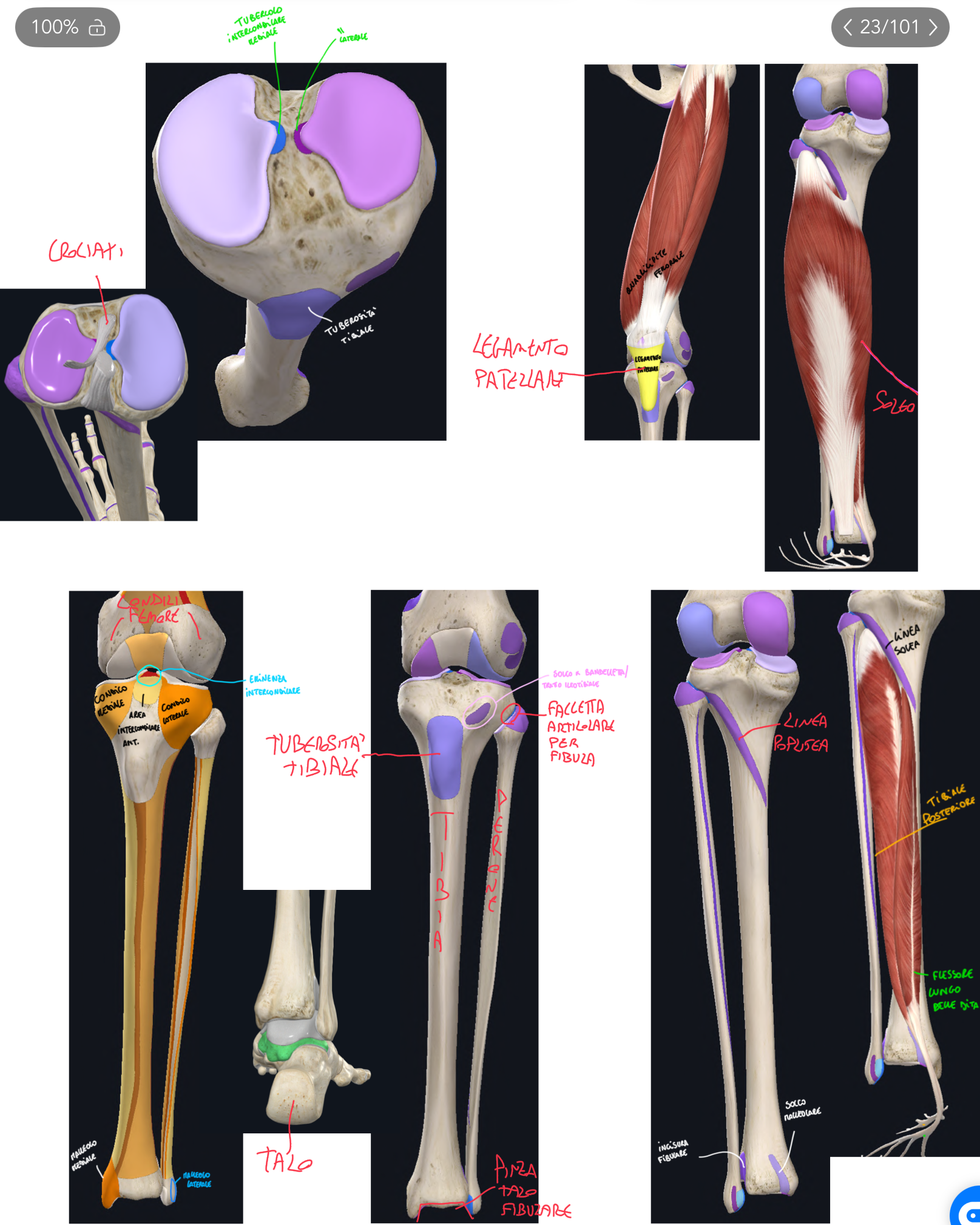 <p>CORPO:</p><ul><li><p>Linea Poplitea → sulla faccia posteriore prossimale, per l’inserzione del Muscolo Soleo (NON il muscolo popliteo)</p></li></ul><p>ESTREMITA’ DISTALE:</p><ul><li><p>Medialmente abbiamo il Malleolo Mediale, che insieme a quello laterale della fibula e alla superficie articolare inferiore della tibia si forma la PINZA TIBIO-FIBULARE che accoglie il TALO (articolazione con il piede)</p></li><li><p>Lateralmente abbiamo l’Incisura Fibulare, che forma l’articolazione tibio-fibulare distale (sindesmosi con fibre collagene)</p></li><li><p>Posteriormente abbiamo il Solco Malleolare dove scorrono i tendini del Muscolo Tibiale Posteriore e Flessore Lungo delle Dita</p></li></ul><p></p>
