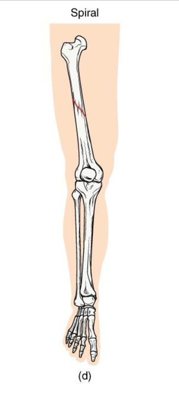 <p><strong>Definition</strong>: Twisting or rotational fracture line around the bone</p><p><strong>Mechanism</strong>: <strong>Rotational force</strong> (ex: skiing, twisting fall, child abuse case)</p><p><strong>Clinical note</strong>: Jagged edges → difficult reduction; may damage surrounding soft tissue.</p><p><strong>Key Concept</strong>: Indicates torque forces; look for rotational injury pattern</p>