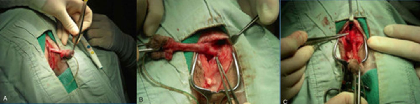<p>What is this, where you free the penis and distal urethra, elevate the penis dorsally, and transect muscles at insertion on ischium?</p>