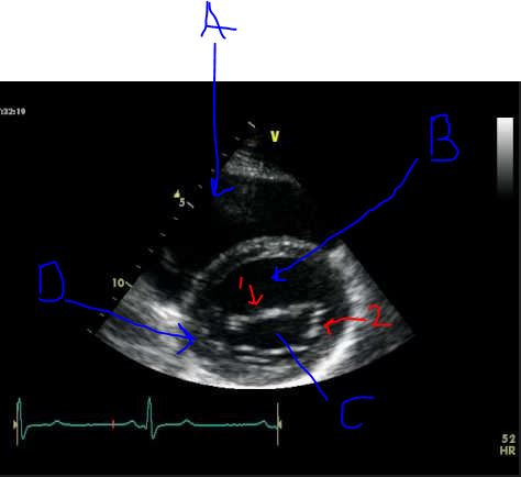<p>Match anatomy in the SAX BASAL/MV</p>
