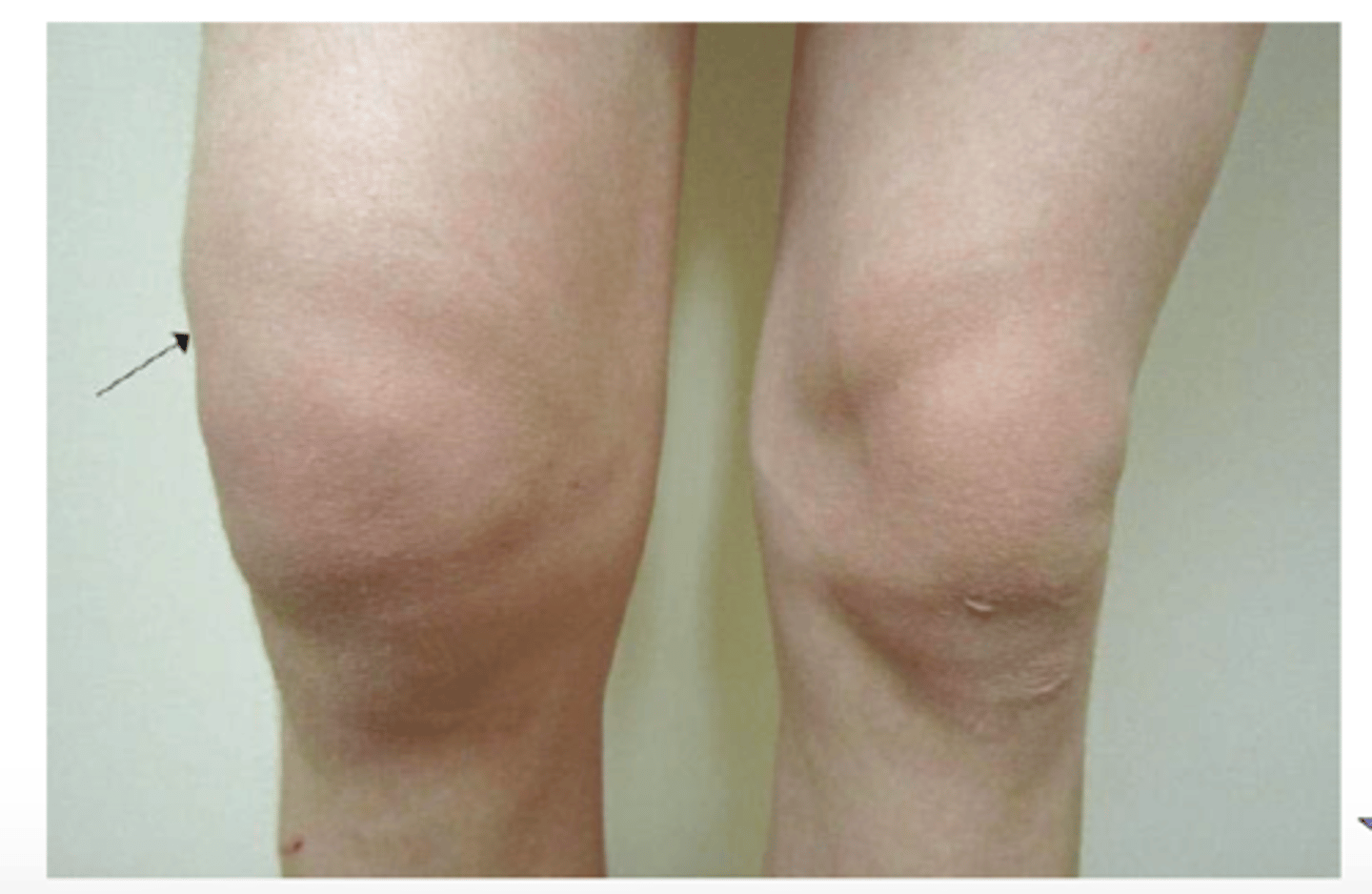 <p>includes cerebral edema, pleural effusion, pericardial effusion, ascites</p>