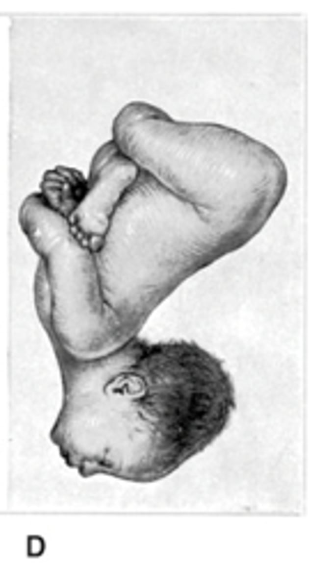 <p>head is extended, and the fetal occiput is near the fetal spine</p>