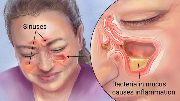 <p>Inflammation of paranasal sinuses</p>