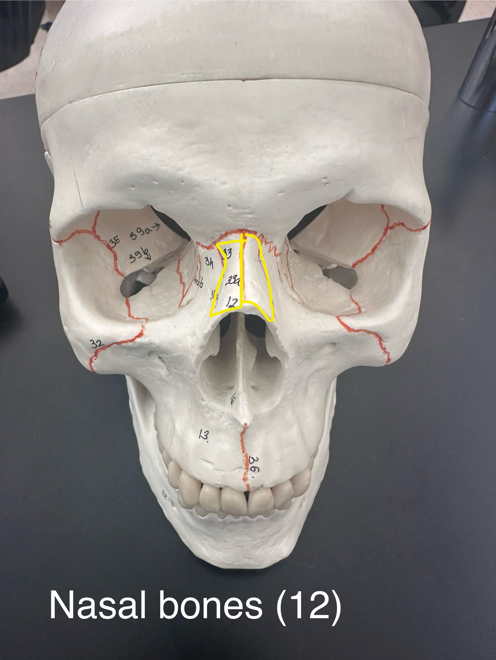 <p>Nasal Bones</p>