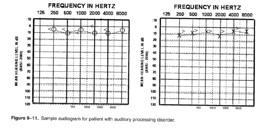 <ul><li><p>significant difficulty processing speech and other complex sound patterns</p></li><li><p>hearing threshold may be in normal range</p></li></ul>