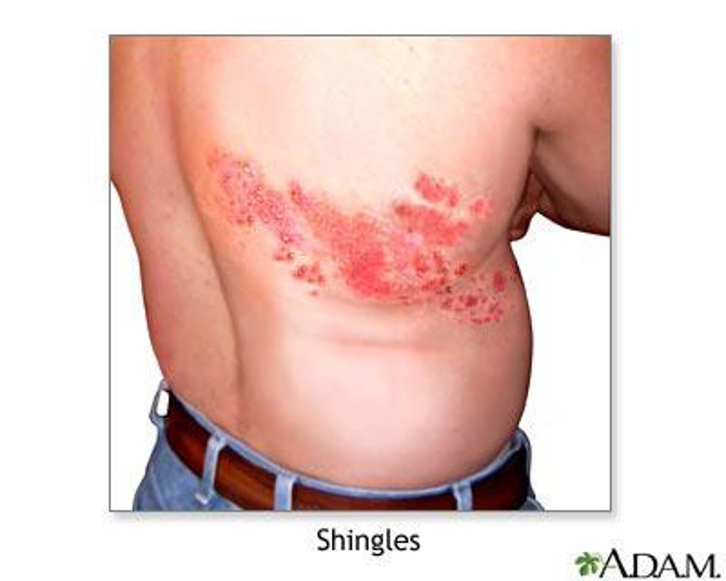 <p>-reactivation of the varicella zoster virus stored in nerves</p><p>-painful rash at dermatome</p><p>-red base, blisters, pain</p><p>-can also have headache, fatigue, light sensitivity</p><p>-vaccine exists (Shingrix)</p><p>-antivirals (acyclovir, valacyclovir, etc) for treatment</p>