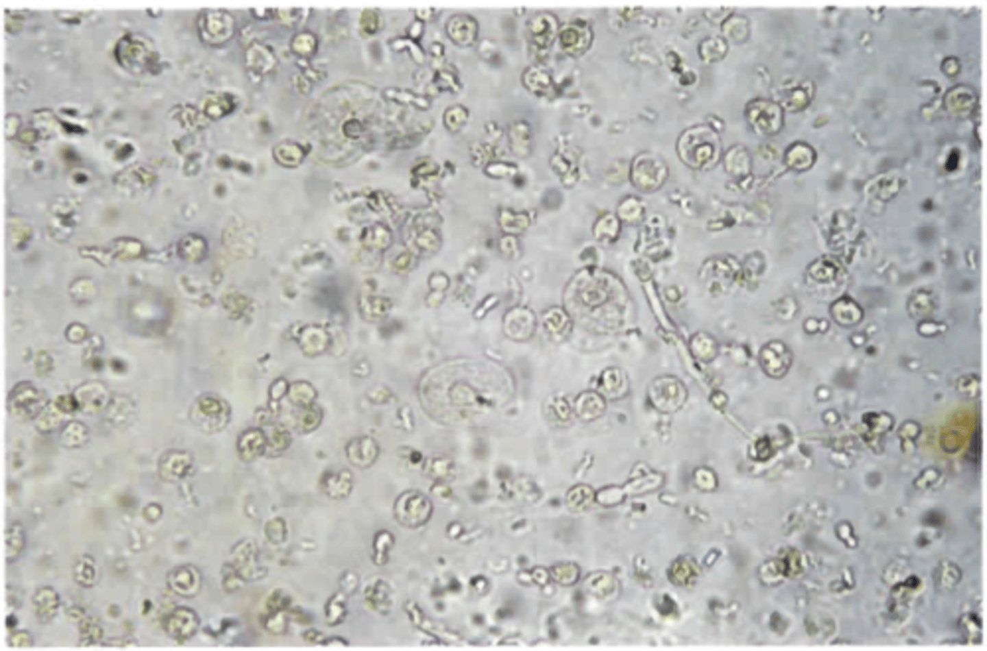 <p>B. The major formed elements are white</p><p>blood cells and yeast.</p><p>There are minimal bacteria present in Color Plate 46. Both budding yeast and white blood cells predominate this microscopic field. Patients with diabetes mellitus are prone to such yeast infections because of the increased glucose in their urine. The epithelial cells visualized in this field are transitional and not squamous. They can be distinguished by their size (about 15-20 um), less cytoplasm than a squamous cell would have, and their central nucleus. Increased squamous epithelial cells would suggest improper</p><p>collection, whereas transitional cells, if greater than 5 cells/hpf, would indicate pathology. There are fewer than 5 red blood cells in this field, and that would be below the sensitivity of the blood pad on the reagent strip.</p>