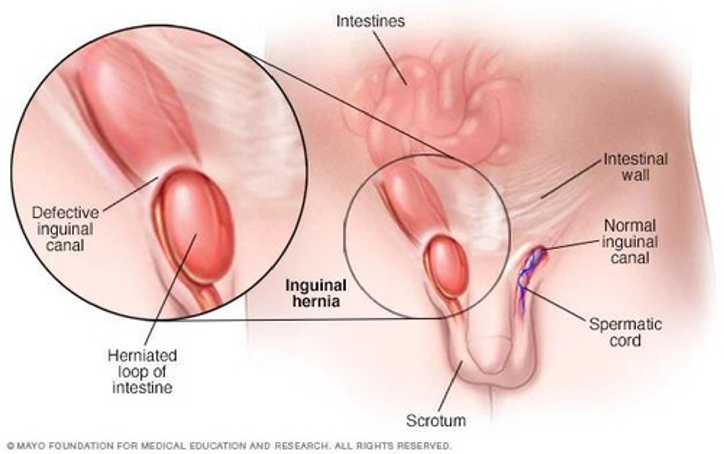 <p>Protrusion of tissue through abdominal wall.</p>