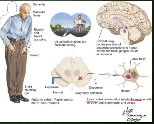 <p><strong>Dementia with Lewy Bodies (DLB)</strong></p><p>-______ hallucinations</p><p>-_____________</p><p>-Fluctuating alertness</p><p>-Neuroleptic sensitivity</p><p>-_____ eye movement (REM) sleep behavior disorder (RBD)</p><p>-Hyposomnia and excessive daytime ____________</p><p>-Delusions related to persecution, invasion, and person or place identity</p>