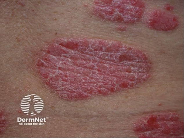 <p>what subtype of psoriasis?</p><ul><li><p><strong>erythematous plaques w. silver scales</strong></p></li><li><p><strong>sharply defined well demarcated</strong></p></li><li><p>± pruritus</p></li><li><p>positive auspitz, koebner</p></li><li><p><strong>extensor surfaces</strong>, scalp, palms/soles (<u>painful fissures)</u> </p></li></ul><p></p>