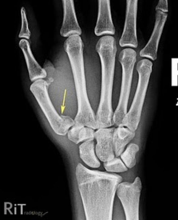 <p>Name this fracture</p>