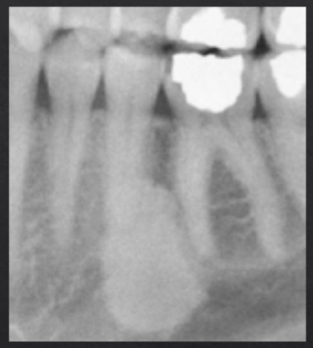 <p>Region of dense radiopaque bone, blends with surrounding bone</p>