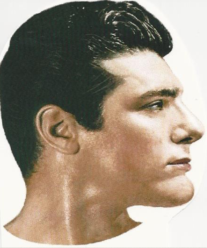 <p><span>Receding forehead; Protruding Chin</span></p>