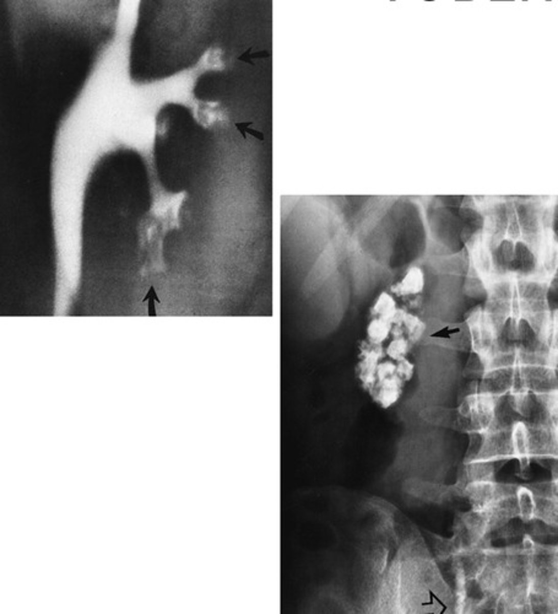 <p>- What bacterial infection spreads throughout the bloodstream and causes ulcerative destruction of the renal tissues and enlarges the calyces?</p><p>- What is seen throughout the parenchyma of the kidney?</p><p>- What stops happening, due to strictures in the ureters?</p>