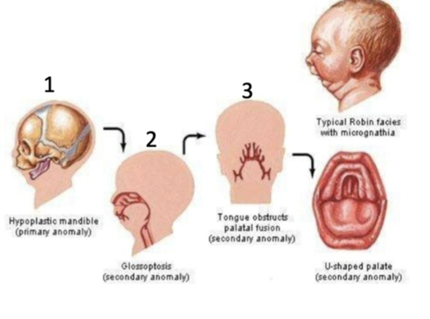 <p>What are the three key features of Pierre Robin Sequence? </p>
