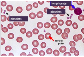 <p><span style="background-color: transparent; font-family: "Times New Roman", serif;">*Blood test:</span></p><p><span style="background-color: transparent; font-family: "Times New Roman", serif;"> 1. RBC count</span></p><p><span style="background-color: transparent; font-family: "Times New Roman", serif;"> 2. Hb concentration</span></p><p><span style="background-color: transparent; font-family: "Times New Roman", serif;"> 3. MCV (normo-, micro-, macro- cytic)</span></p><p><span style="background-color: transparent; font-family: "Times New Roman", serif;"> 4. Red cell distribution width (RDW)</span></p><p><span style="background-color: transparent; font-family: "Times New Roman", serif;">→ calculate hemocrit, MCH, MCHC to compare values adjusted for age and sex</span></p><p><span style="background-color: transparent; font-family: "Times New Roman", serif;">*Other tests: serum iron, serum B12, Hb electrophoresis</span></p><p><span style="background-color: transparent; font-family: "Times New Roman", serif;">*Microscopic examination of a stained blood smear</span></p><p><span style="background-color: transparent; font-family: "Times New Roman", serif;">*Can also do bone marrow biopsy if diagnosis still difficult</span><br></p><p><span style="background-color: transparent; font-family: "Times New Roman", serif;">NORMAL RBCS:</span></p><p><span style="background-color: transparent; font-family: "Times New Roman", serif;">*uniform in size and shape</span></p><p><span style="background-color: transparent; font-family: "Times New Roman", serif;">*<strong>diameter ~ nucleus of a lymphocyte</strong></span></p><p><span style="background-color: transparent; font-family: "Times New Roman", serif;">*<strong>central pallor = 1/3 of rbc diameter</strong></span></p>