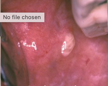 <p>What do you see in acute sialadenitis?</p>