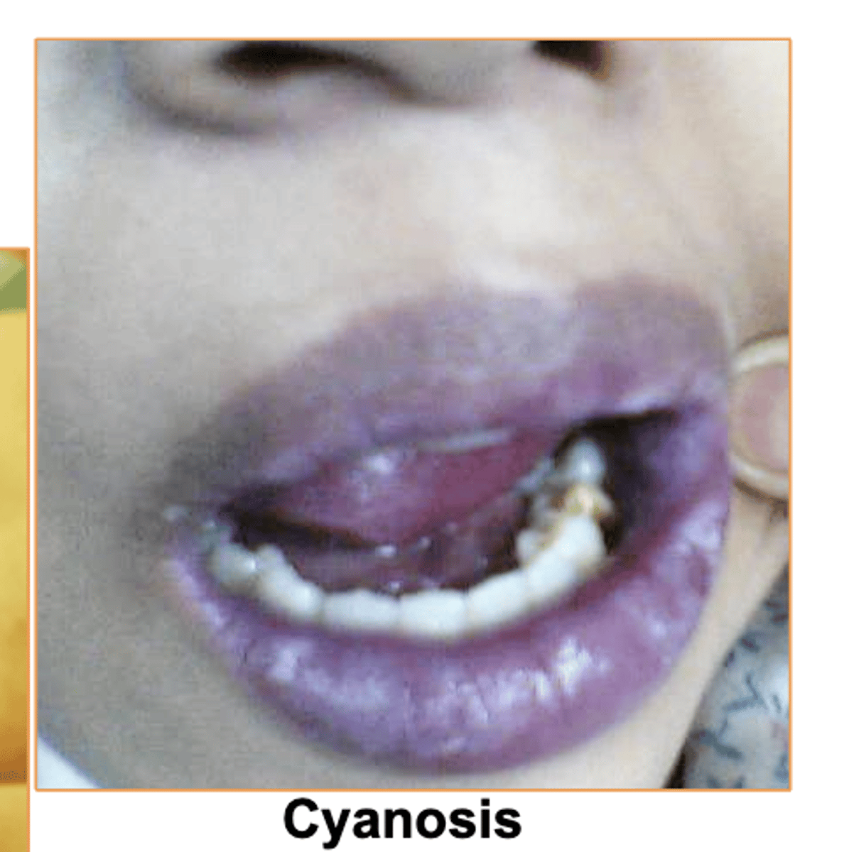 <p>bluish discoloration from deficiency of oxygen</p><p>Some causes- Airway obstruction (drowning or choking) andlung diseases (emphysema</p>