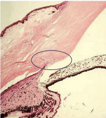 <p>Also called sinus venosus sclerae <br>Located anterior to scleral spur<br>Provides an exit for AH and nourishment for adjacent tissues <br>Lined by endothelial cells with <strong>incomplete </strong>basement membrane</p>