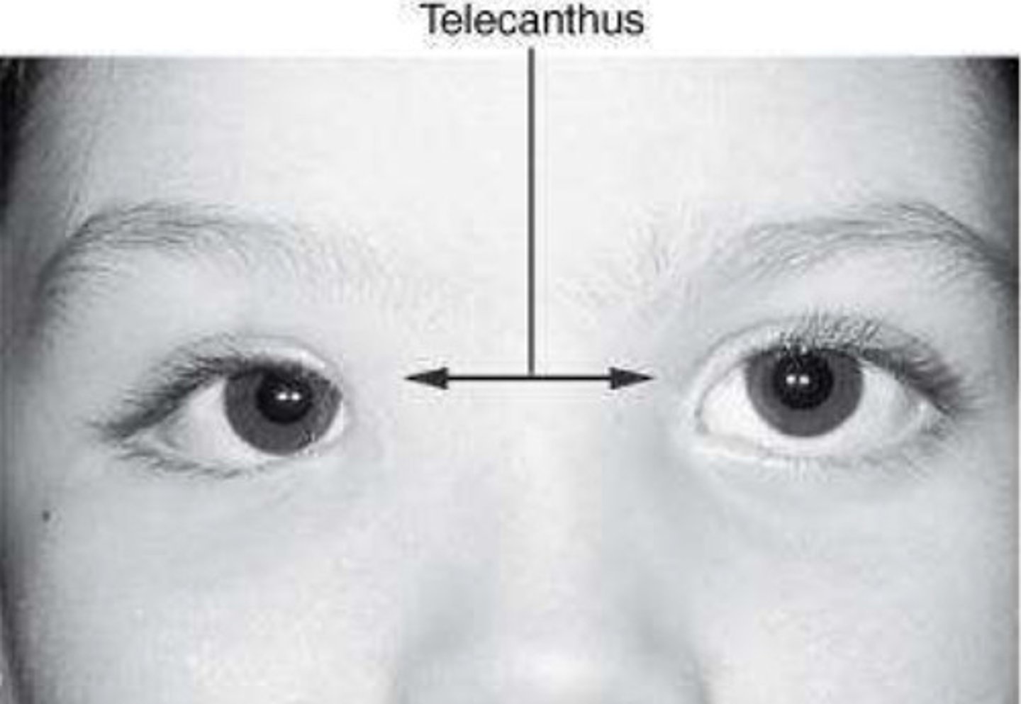 <p>Abnormally increased distance between the medial canthi of the eyelids</p>