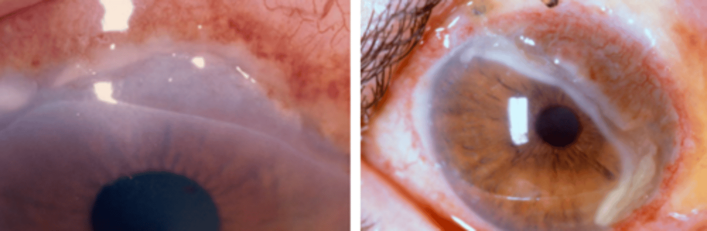 <p>a painful, progressive, idiopathic chronic ulcerative keratitis that begins peripherally and move circumferentially and centrally. Appears as a grey white crescent shape with vascularization leading to the edge of the ulcer. Is more common in men and 40-70 yo. Is usually unilateral. Has no associated systemic disease or scleritis. Management begins with steroids, prophylactic antibiotics, and supportive therapy.</p>