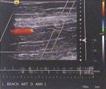 <p>What is most likely interpretation of arterial flow in the brachial artery according to this duplex image?</p>
