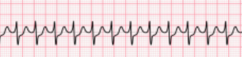 <p>Identify the Above A-V Arrhythmia:</p><ul><li><p><span>above 150s-170s HR</span></p></li><li><p><span>burrowed P waves (no atrial depolarization)</span></p></li><li><p><span>narrow QRS complex</span></p></li></ul><p></p>