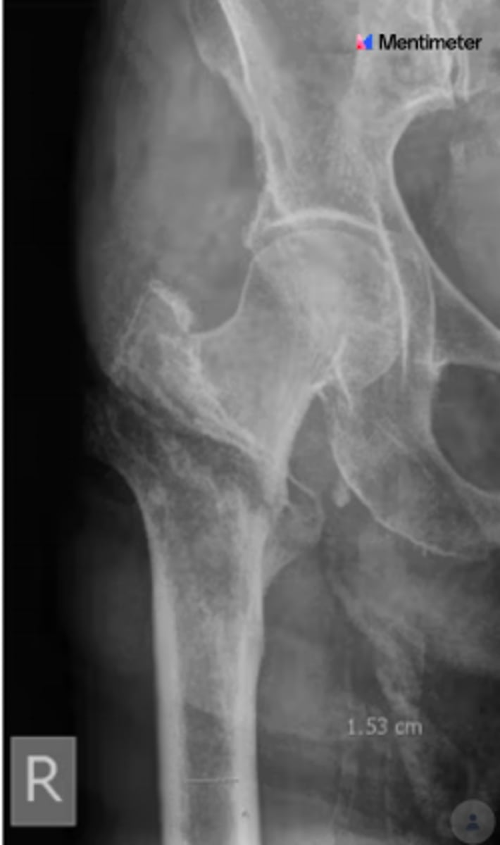 <p>How would you classify this fracture?</p>