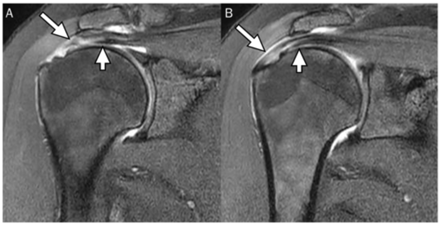 <p>What are these images depicting w/ the rotator cuff? What is our concern?</p>