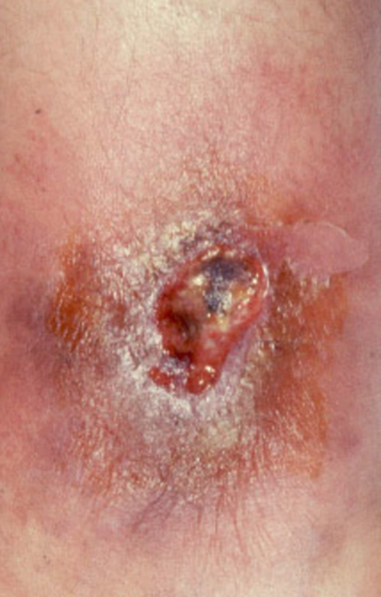 <p>A sexually transmitted disease caused by Spirochete, Treponema pallidum affecting multiple systems</p><p>Can be passed from mother to fetus via transplacental vertical transmission</p><p>Incubation period is 10-90 days</p>