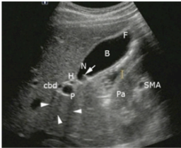 <p>What does a normal gallbladder look like in Long Axis?</p>