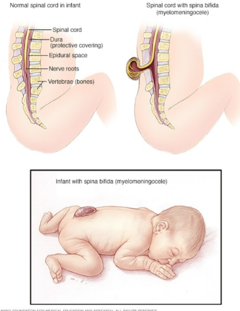 <p>What is spina bifida?</p>
