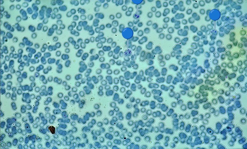 <p><span data-name="drop_of_blood" data-type="emoji">🩸</span><span data-name="microbe" data-type="emoji">🦠</span><span><span> </span></span><strong><em>Plasmodium sp. </em></strong><sub>(Schizont segmenter)</sub></p><p></p><p></p><p><span>🔵 - schizont segmenter.</span></p><p></p><p></p><p><span>😷❓ </span><strong>Parazytoza:</strong><em> Malaria</em></p>