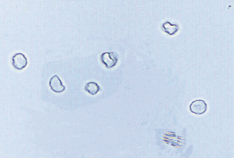 <p>Dysmorphic RBC in urine</p><p>Altered shape of red blood cells, often seen due to glomerular injury and indicative of renal pathology.</p>