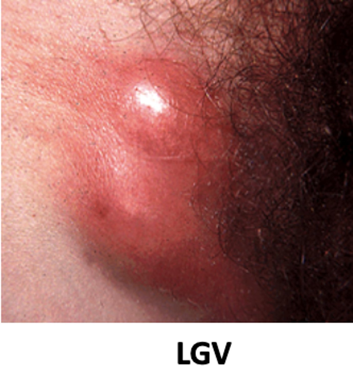 <p>Local</p><p>Dissemination</p><p>Progressive tissue damage</p>