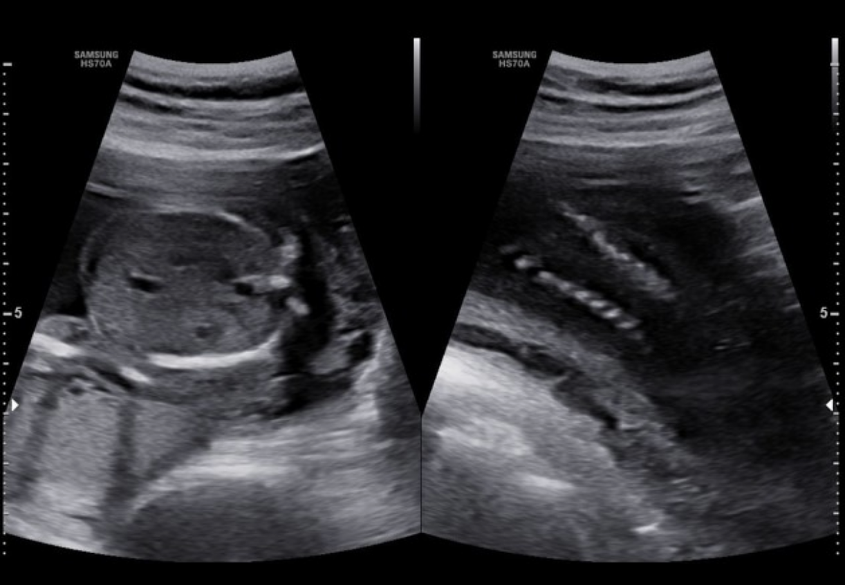 <p>what is the <strong>most severe form </strong>of<strong><u> spina bifida</u></strong> that causes a <strong>cleft through the entire spine</strong> + <strong>all vertebrae</strong> are <strong>splayed</strong></p><p>.</p><p>a) myelomeningocele</p><p>b) holoprosencephaly</p><p>c) rachischisis [failure of neurulation]</p><p>d) spina bifida occulta</p>