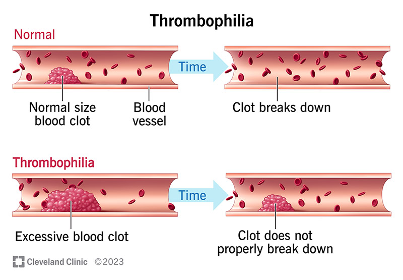 <p><strong>Increased tendency to form blood clots</strong> can lead to<strong> coronary thrombosis.</strong></p>