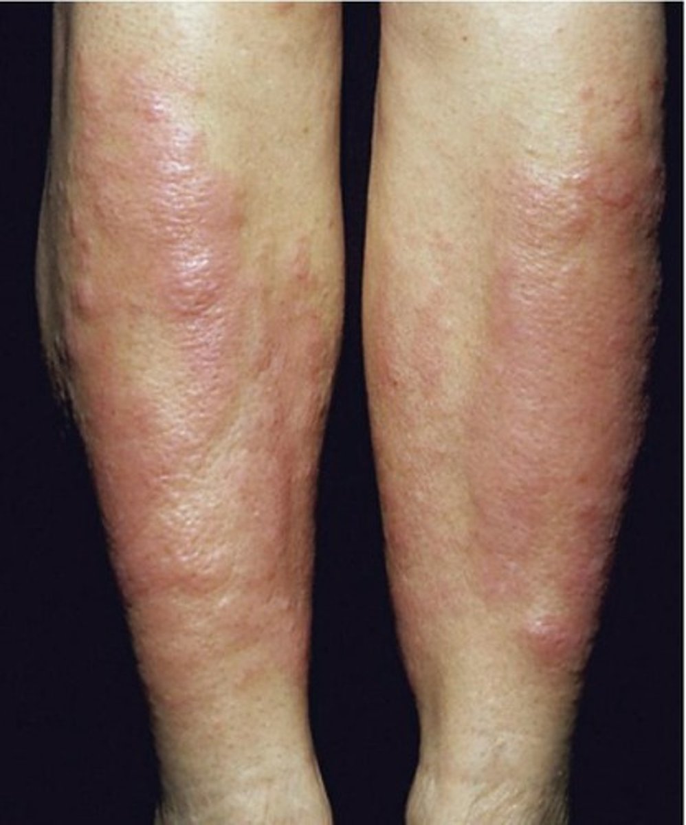 <p>Due to accumulations of mucopolysaccharides</p><p>Changes are reversible with thyroid hormone</p>